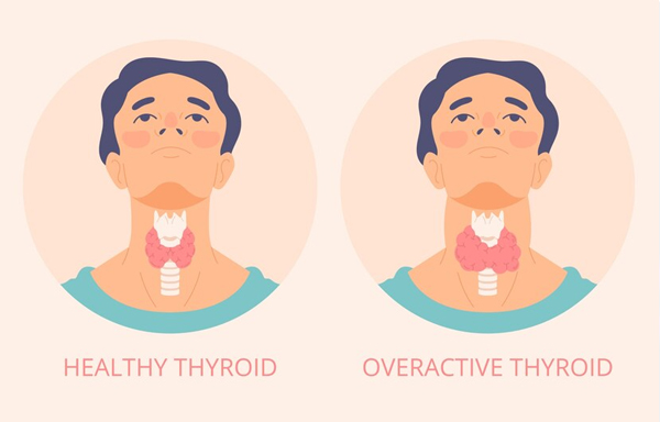 Hypothyroidism