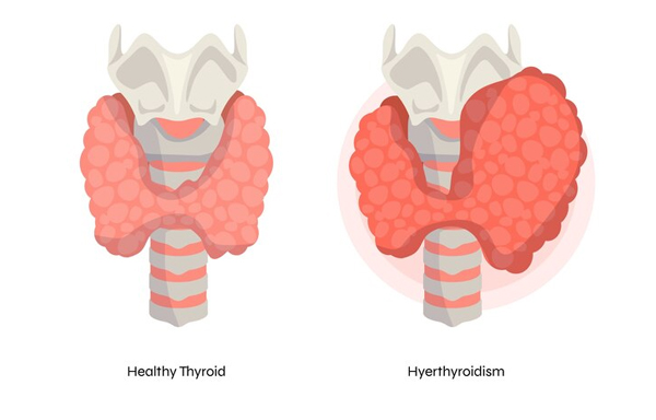 Hyperthyroidism