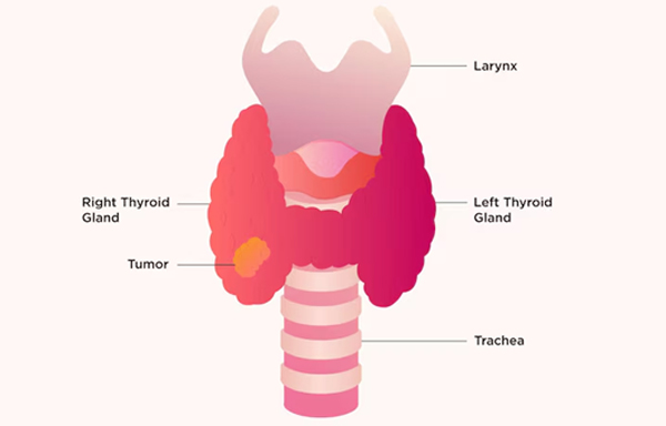 Thyroid Tumours