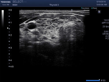 Thyroiditis Ultrasound Radiology