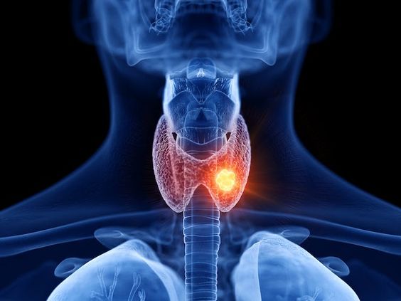 Thyroid Nodule (Many non-cancerous nodules can be treated non-surgically)