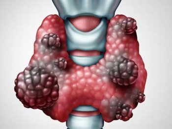 Beyond Surgery: Emerging Therapies For Benign Thyroid Nodules