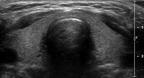 Thyroiditis Evaluation: The Role Of Ultrasound Radiology