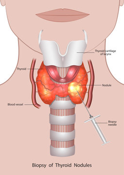 Thyroid Nodule Size And Growth Patterns: Implications For Management