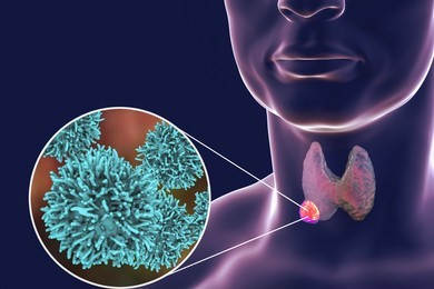 Thyroid Tumours Treatment in Moti Nagar