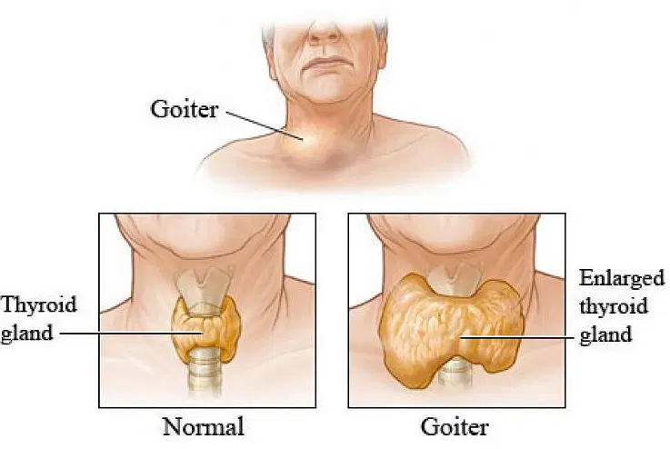 Innovative Therapies And Research In Multinodular Goitre