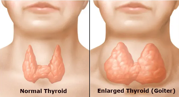 Case Studies And Clinical Trials In Multinodular Goitre Research