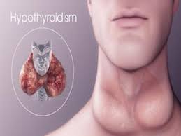 Advances In Hypothyroidism Research And Treatment