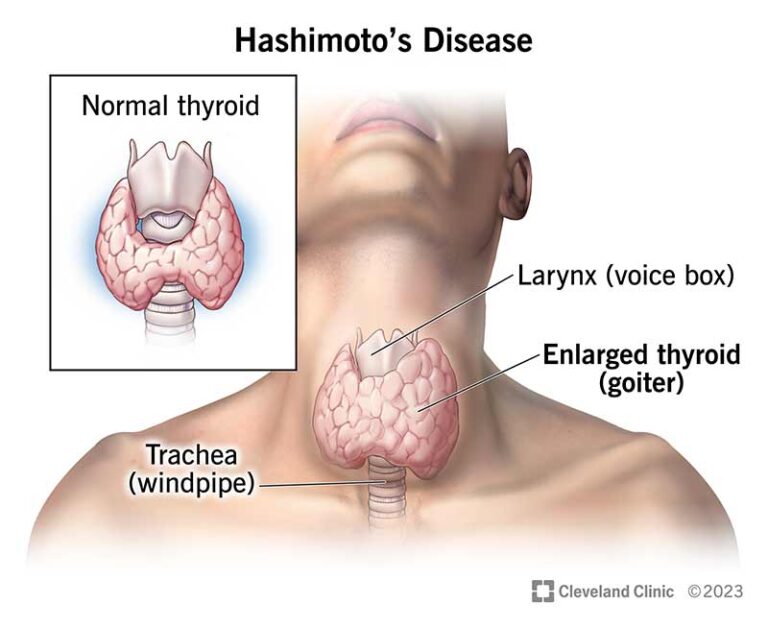 Understanding Thyroiditis: Causes, Symptoms, and Treatment Options