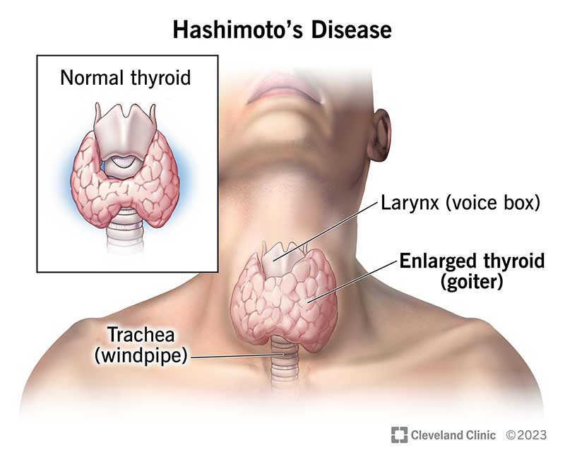 thyroiditis treatment in Moti Nagar