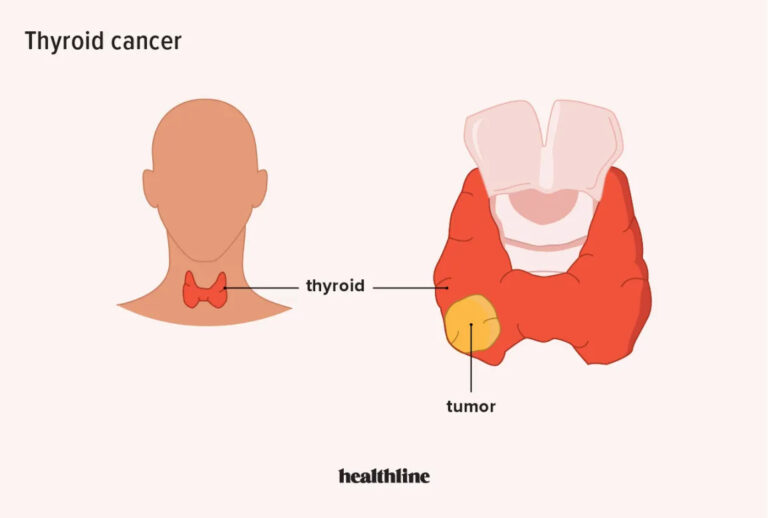 Understanding Thyroid Tumours: Causes, Diagnosis, and Treatment