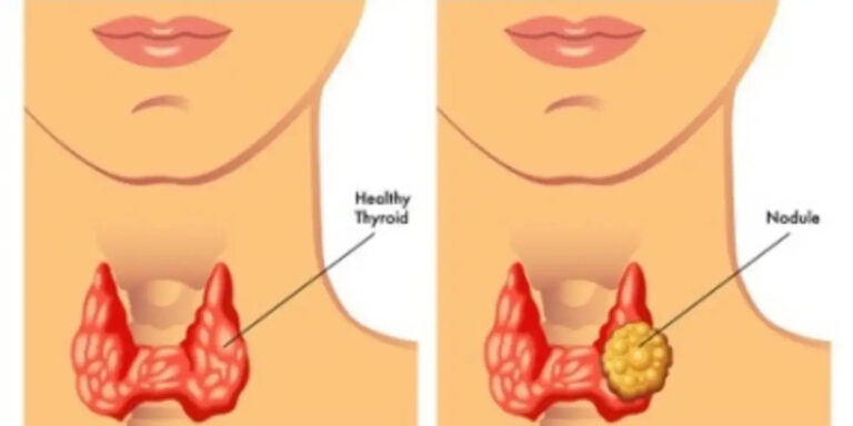 Understanding Thyroid Nodules: Causes, Symptoms, Diagnosis, and Treatment