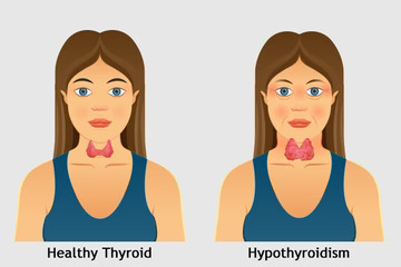 Hypothyroidism Treatment in Moti Nagar