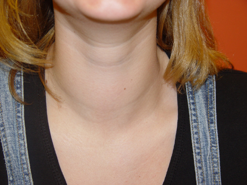 How Simple Goitre Develops: A Closer Look At Thyroid Enlargement