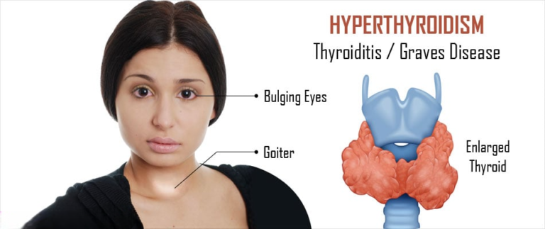 Complications Of Untreated Hyperthyroidism: What You Need To Know