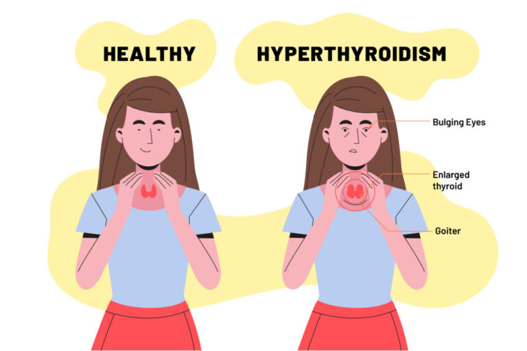 Understanding Hypothyroidism: Causes, Symptoms, and Treatment