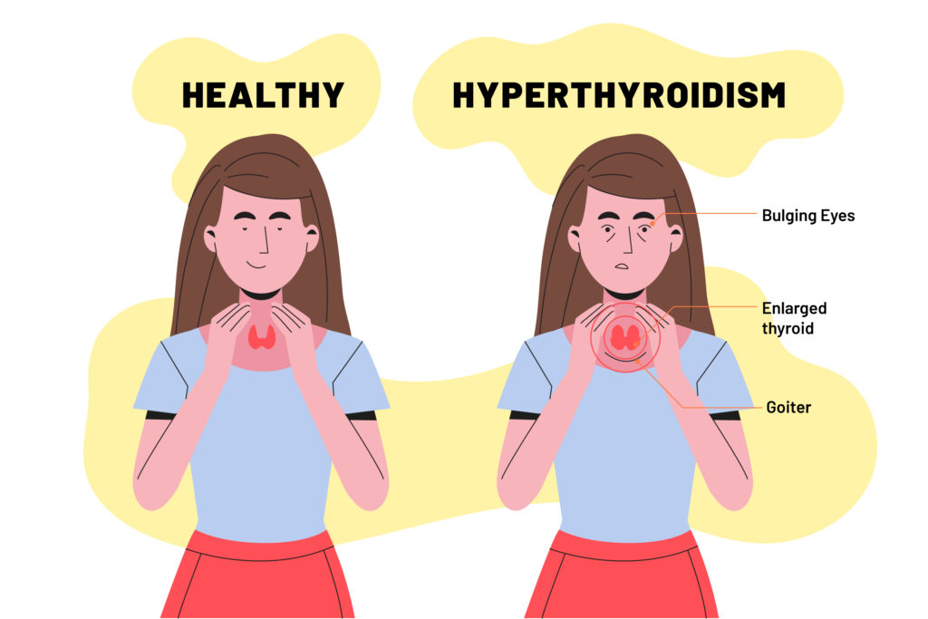 Hypothyroidism Treatment in Moti Nagar