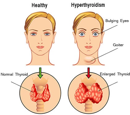 Understanding Hyperthyroidism: Causes, Symptoms, and Treatment